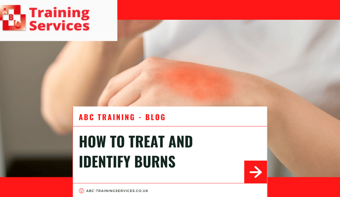 How to treat and identify burns